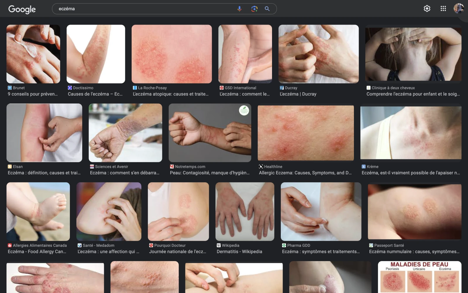 Recherche typique sur Google Image pour l’eczéma.